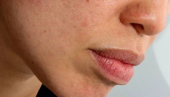 Por que a rosácea costuma piorar depois dos 40 anos, causando rubor facial mais intenso, e como controlar vermelhidão persistente com tratamentos e hábitos