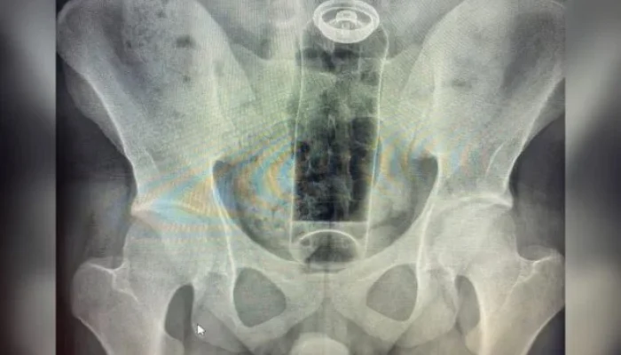 Jovem de 19 anos Internado às Pressas Após Desodorante Ficar Preso no Reto: Risco Médico Grave