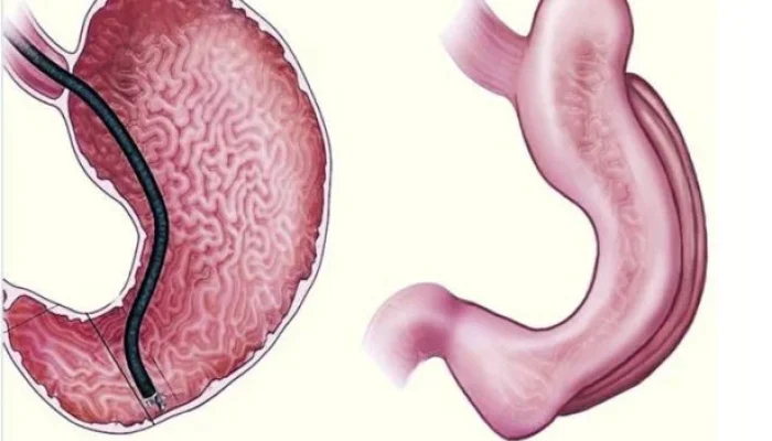 Adeus Canetas Emagrecedoras? Gastroplastia Endoscópica Sem Cortes Promete Perda de Peso Duradoura e Menos Riscos