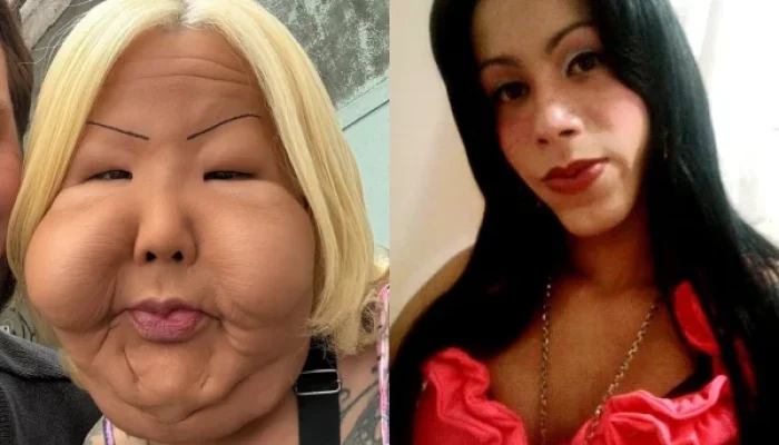 Juju do Pix: A Influenciadora que Luta Contra a Deformação Facial Causada por Óleo Mineral e Busca Reconstrução Após Cirurgia