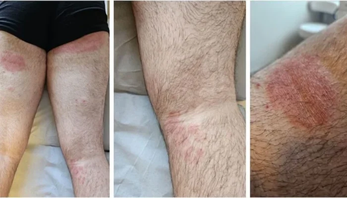 Alerta de Superfungo Genital: Casos de T. indotineae Disparam 500% no Reino Unido e Irlanda, Tratamento Exige Substância Tóxica