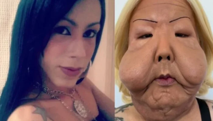 Juju do Pix Choca Web com Reaparecimento Após Cirurgia Reconstrutora para Corrigir Procedimento Estético que Deformou seu Rosto